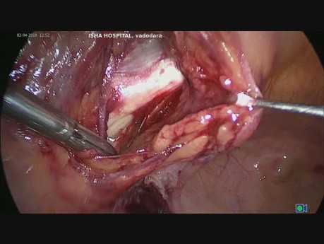 Totale laparoskopische Hysterektomie- Pectopexie