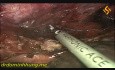 Thorako-laparoskopische Ösophagektomie mit totaler mediastinaler Lymphadenektomie