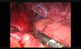 Laparoskopische Heller Kardiomiotomie