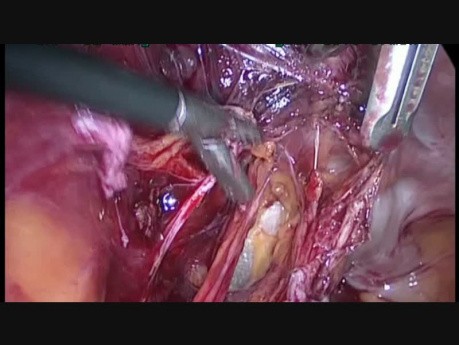 Ureterolyse (der linke Harnleiter)