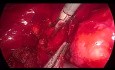 Laparoskopische Exploration des Ductus choledochus. Blutung aus der A. supraduodenalis