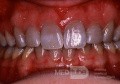 Zahnverfärbungen durch Tetracyclinen