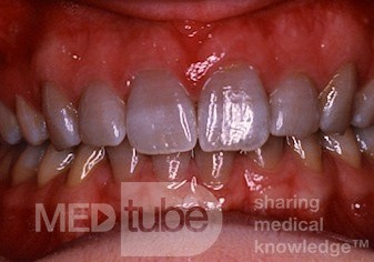 Zahnverfärbungen durch Tetracyclinen