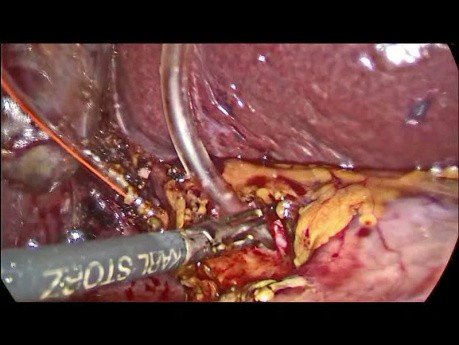 Gallengangssteine ​​- laparoskopische Behandlung