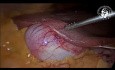 Abnormales Lebergewebe auf der Gallenblasenoberfläche