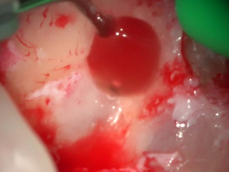 Wurzelspitzenresektion (Wurzelamputation) mit Laser unter Vergrößerung