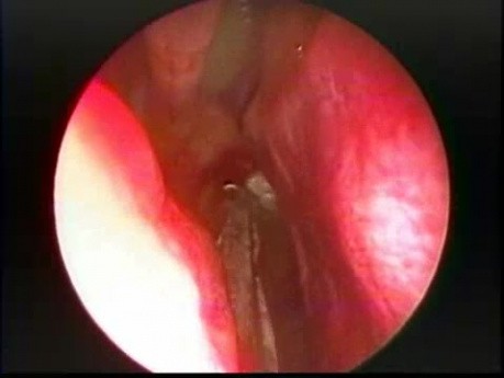 Großer Choanalpolyp - endoskopische Entfernung