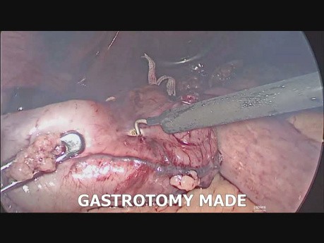Laparoskopische Revisionsadipositaschirurgie (Sleeve-Gastrektomie in einem Mini Magenbypass) 