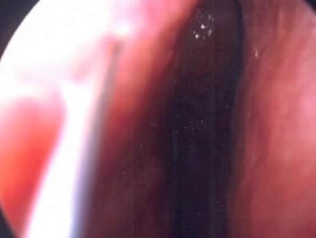 Septumplastik - Endoskopie