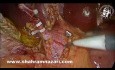 Antegrade Sphankterotomie mit Katheterdilatation während der laparoskopischen Untersuchung des Hauptgallengangs