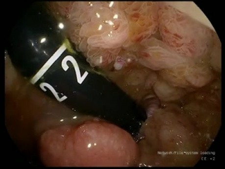 Laparoskopische Einzelzugangchirurgie den Rektumadenom - totale Exzision der Schleimhaut des Rektums