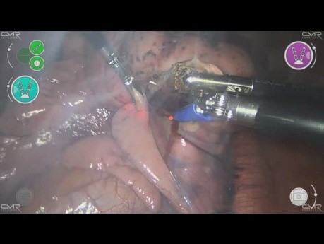 Versius Robot -  Pulmonale Metastasektomie