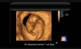4D-Ultraschallaufnahme von einem normalen Fötus in der 11. SSW