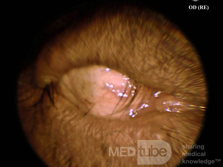 Entropium und Trichiasis