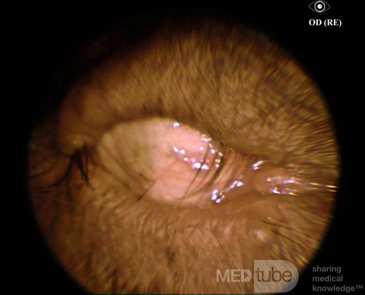 Entropium und Trichiasis