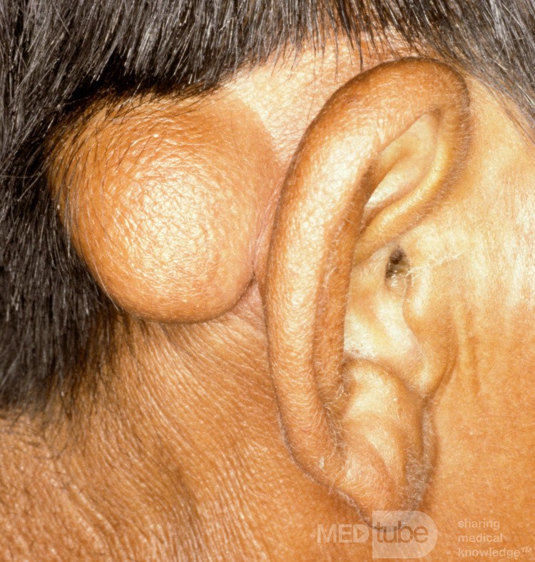 Trichilemmalzyste 