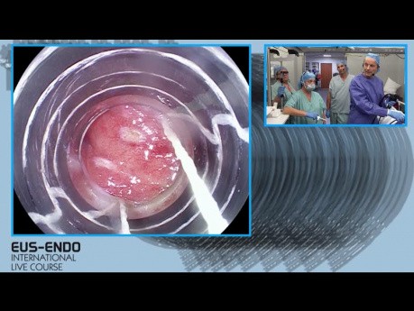 Endoskopische Mapping-Biopsien und Resektion beim Carcinoma in situ des Ösophagus
