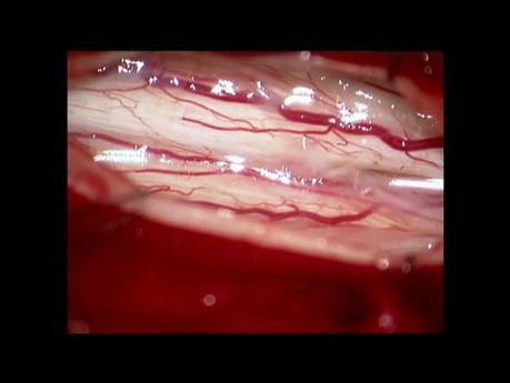 Syringomyelie