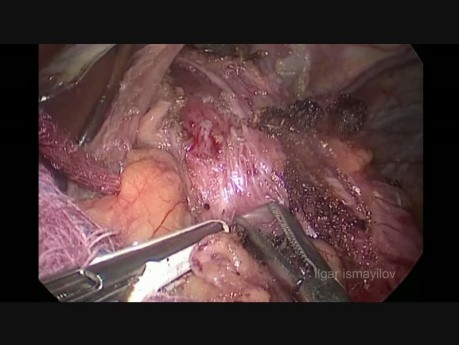 Laparoskopische Heller Kardiomyotomie mit Dor Fundoplikatio - Behandlung von Achalasie