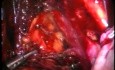 Entfernung von Lymphknoten mit laparoskopischen Techniken