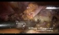 Totale laparoskopische Hysterektomie- Zustand nach 3 Kaiserschnitten