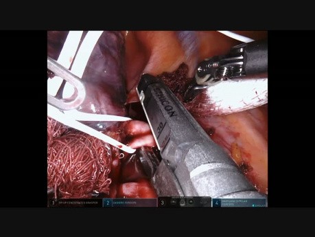  Bronchialkarzinom Oberlappen rechts - roboterassistierte Lobektomie