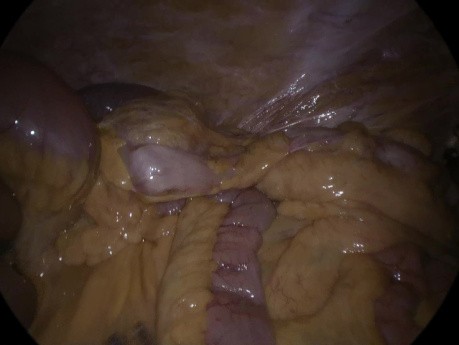 Innere Hernie nach laparoskopischer kolorektaler Operation