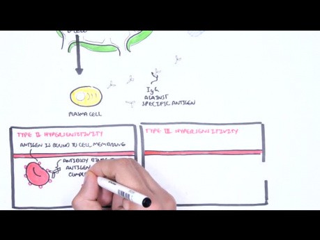 Typ-III-Allergie (Allergie vom Immunkomplex-Typ) - Ursachen, Pathophysiologie