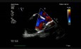 Atriumseptumdefekt Sinus Venosus - obere Hohlvene