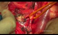 Zytoreduktive Chirurgie des Eierstockkrebses. Hysterektomie nach Hudson.