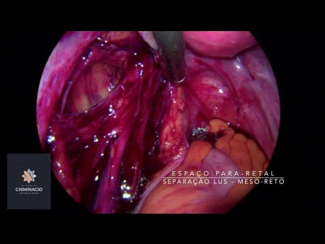 Endometriose und Unfruchtbarkeit