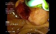 Papilläres Adenokarzinom, diagnostiziert mit EUS und ERCP