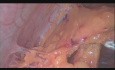 Totale laparoskopische Hysterektomie, bilaterale Salpingo-Oophorektomie, Peritonealwaschungen und Omentalbiopsie