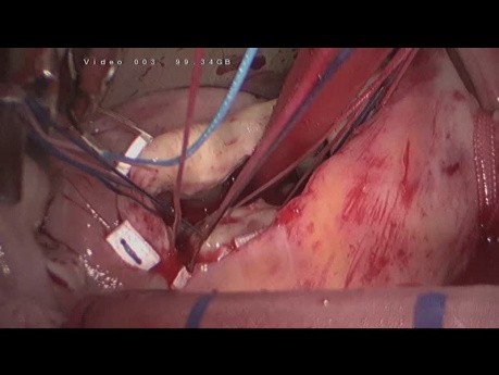 Trikuspidalkarzinom, endoskopische Chirurgie