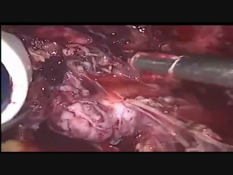 Ureterverletzung – großes zervikales Myom
