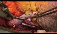 Mini-Inzisions-Nierentransplantation