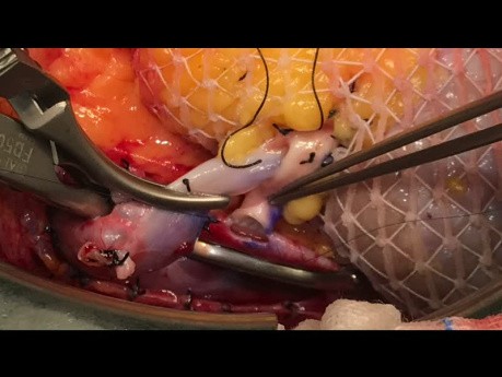 Mini-Inzisions-Nierentransplantation