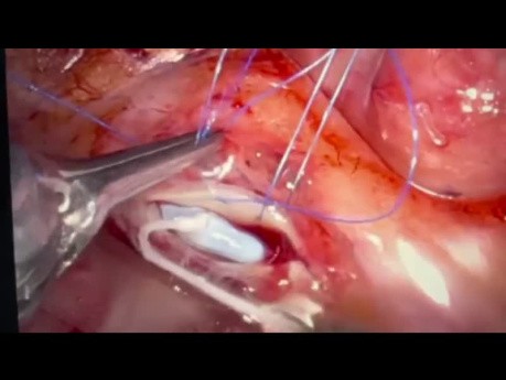 Robotische Koronararterien-Bypass-Transplantat