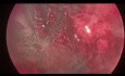 Adenokarzinom des oberen Rektumdrittels - Rezidiv