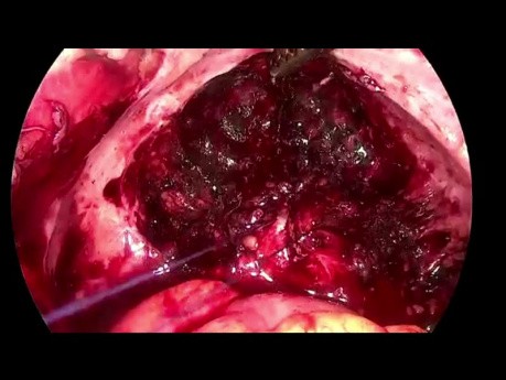 SELS: tief-infiltrierende Endometriose