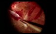 Glaskörperdissektion bei Traktionsnetzhautablösung bei proliferativer diabetischer Retinopathie