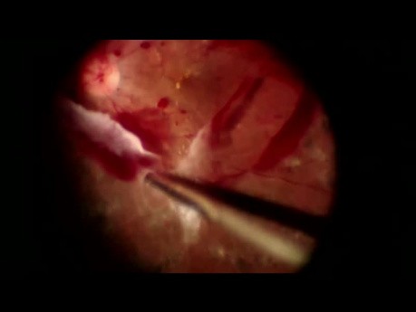 Glaskörperdissektion bei Traktionsnetzhautablösung bei proliferativer diabetischer Retinopathie