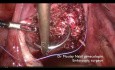Myomektomie mit Kontrolle der inneren Beckenarterien