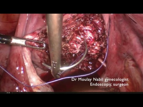 Myomektomie mit Kontrolle der inneren Beckenarterien