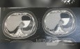 Nissen Fundoplikatio CT-Scans
