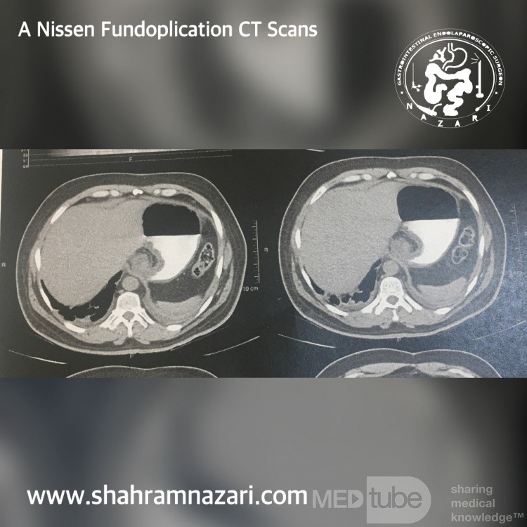 Nissen Fundoplikatio CT-Scans