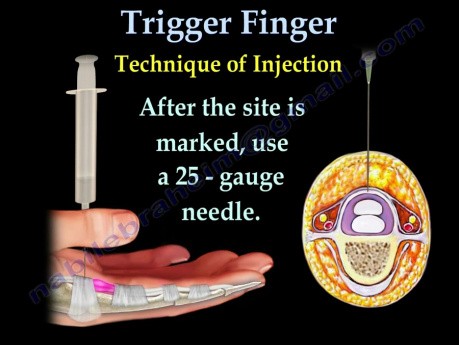 Schnellender Finger - Videovortrag