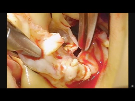 Minimal-invasives Bentall-Verfahren