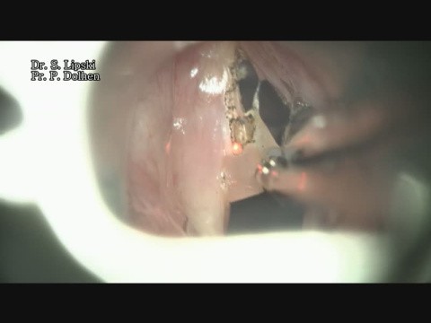 EDEMA DE REINKE