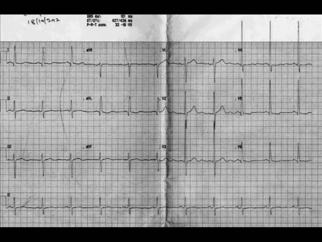 Kardiologie-Quiz 1 – Echokardiographie-Fall. Ein Patient mit einem Herzgeräusch, EKG, Echo und Behandlung